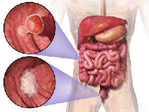 Kanker Usus Besar Semakin Mengincar Usia Muda, Apa Penyebabnya?