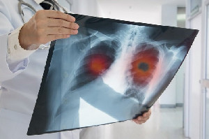 514 Lab dan CT Scan Dosis Rendah Disiapkan untuk Perangi Kanker Paru