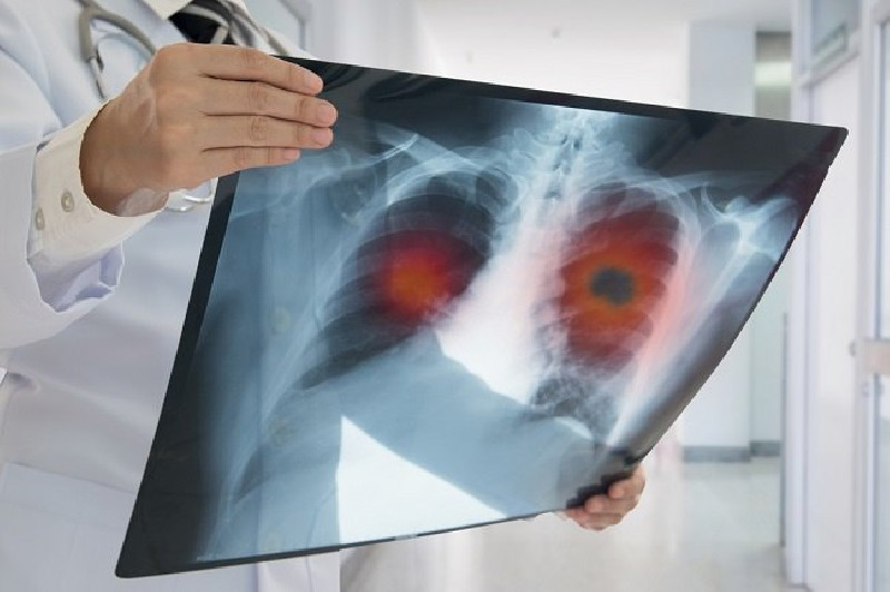 514 Lab dan CT Scan Dosis Rendah Disiapkan untuk Perangi Kanker Paru