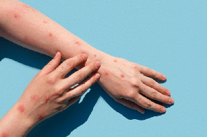 Kemenkes Catat 92 Kasus Mpox di Indonesia, Varian Clade Ib Jadi Perhatian