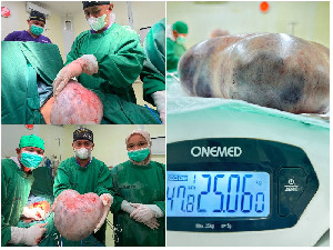 RSUD Sultan Iskandar Muda Nagan Raya Berhasil Angkat Tumor Raksasa 25 Kg